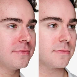 Anti-Blemish Solutions Clinical Advanced Clearing Gel