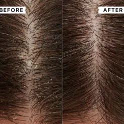Flaky-Itchy Scalp Anti-Dandruff Shampoo